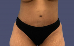 Abdominoplasty (Tummy Tuck) 23 After